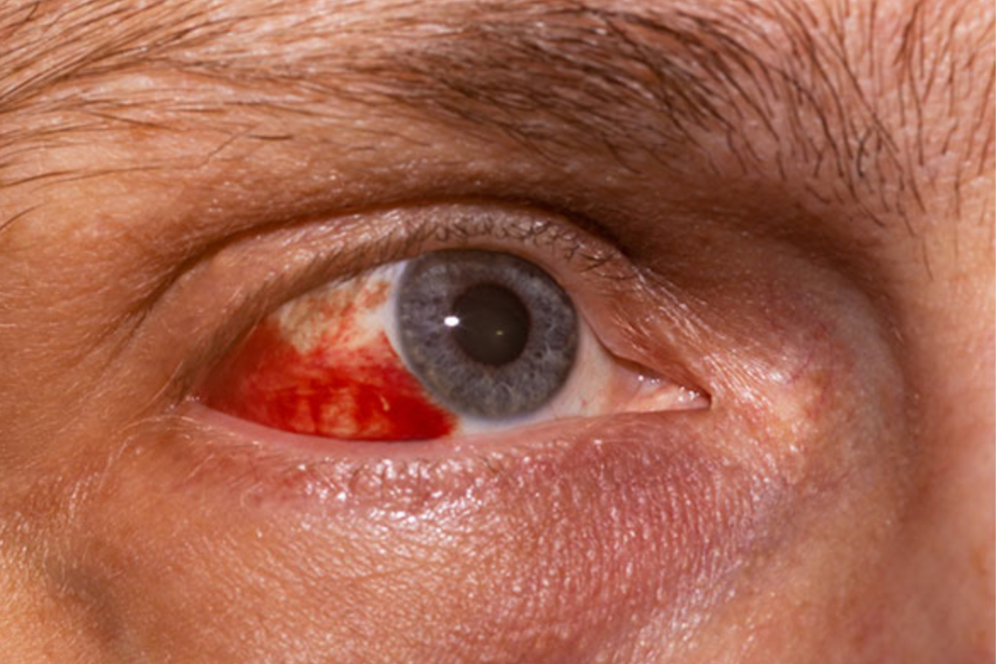 As� es como se ve una retinopat�a solar.