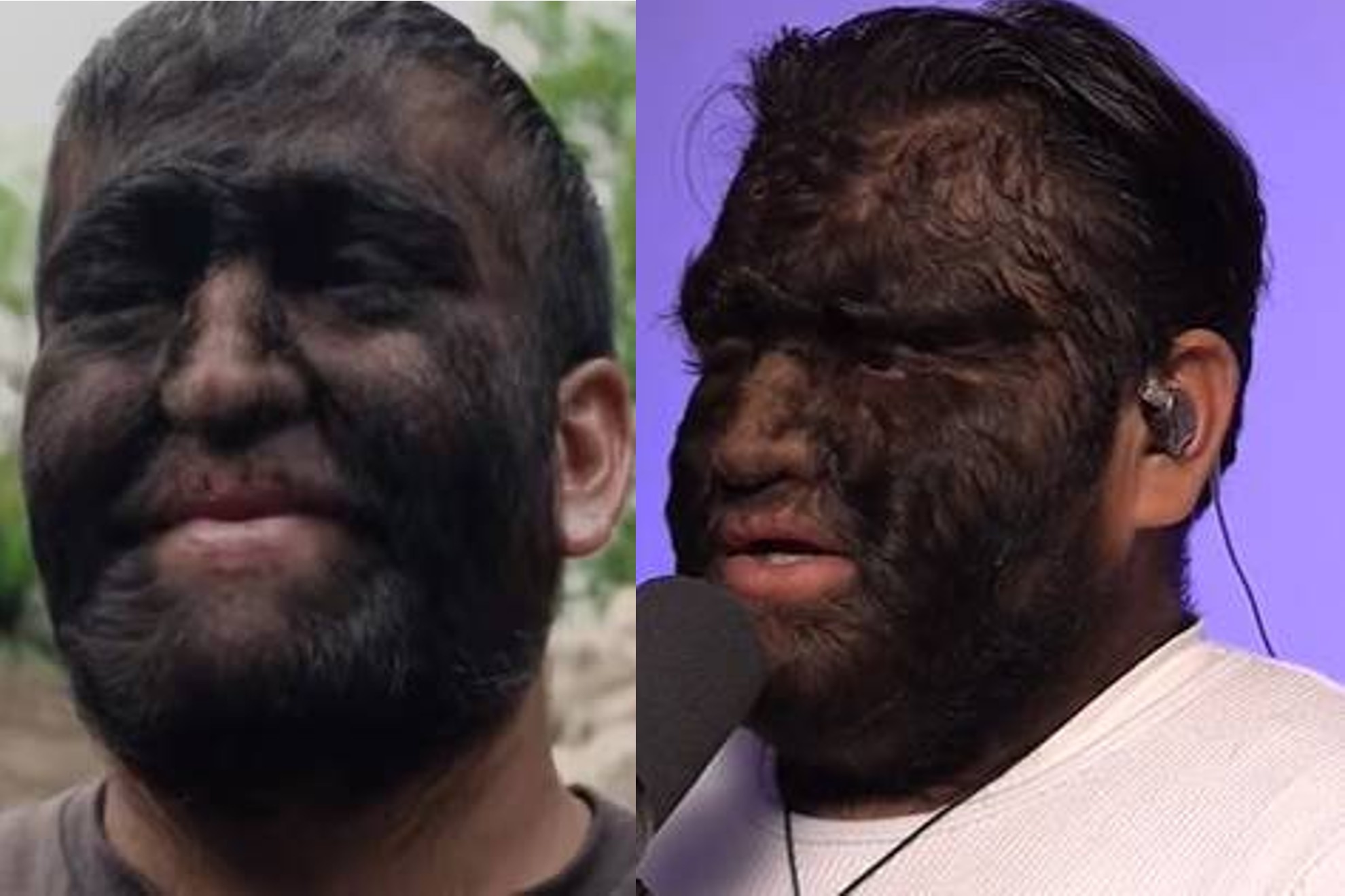 Jes�s Fajardo sufre  hipertricosis cong�nita; por ello le llaman el Hombre Lobo de Zacatecas