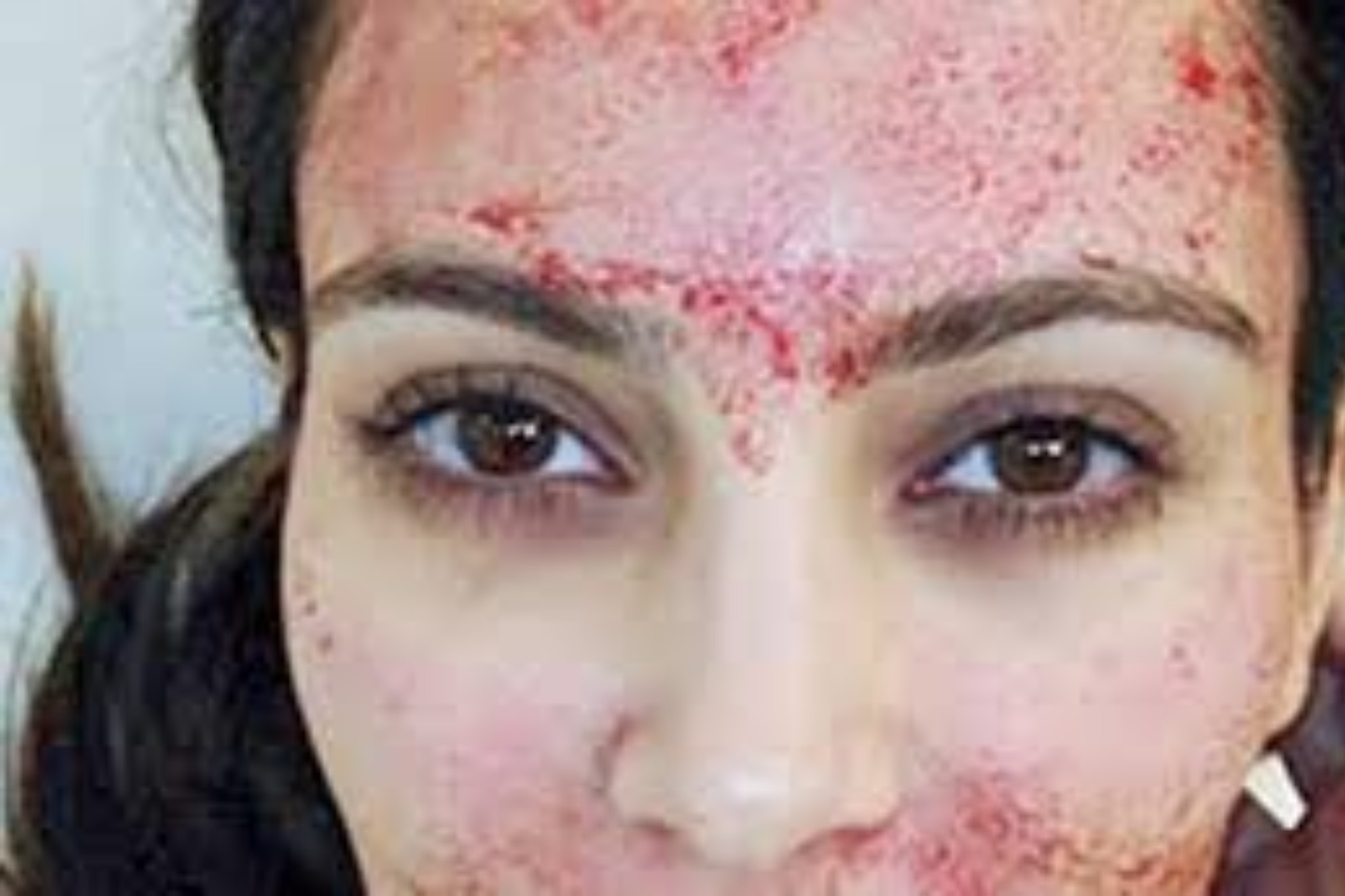 �Qu� son los faciales vampiro? Procedimiento pol�mico que se aplica Kim Kardashian
