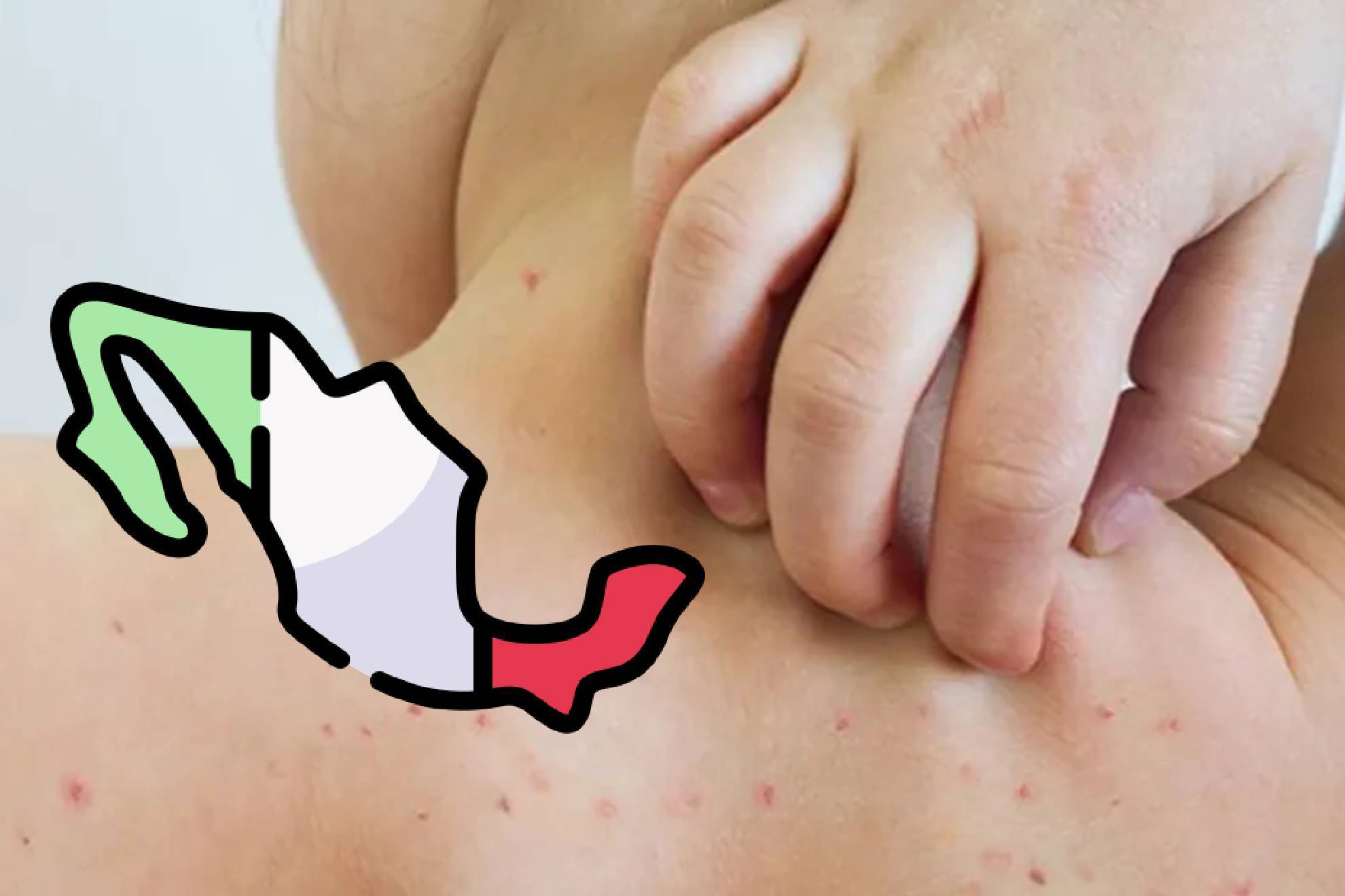 M�xico es el pa�s con m�s muertes en Latinoam�rica por sarampi�n.