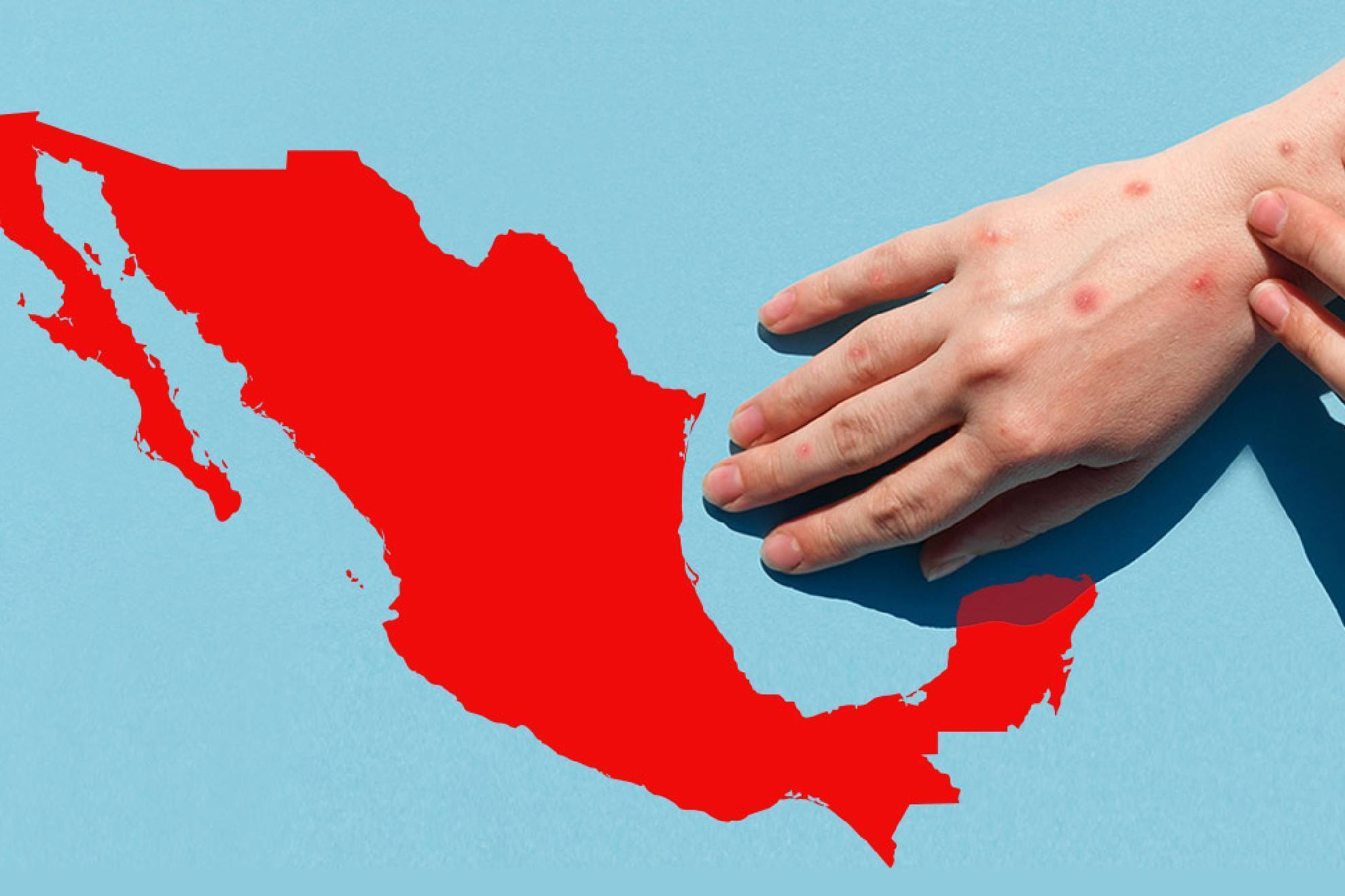 M�xico es el pa�s con m�s muertes por sarampi�n en Am�rica Latina.