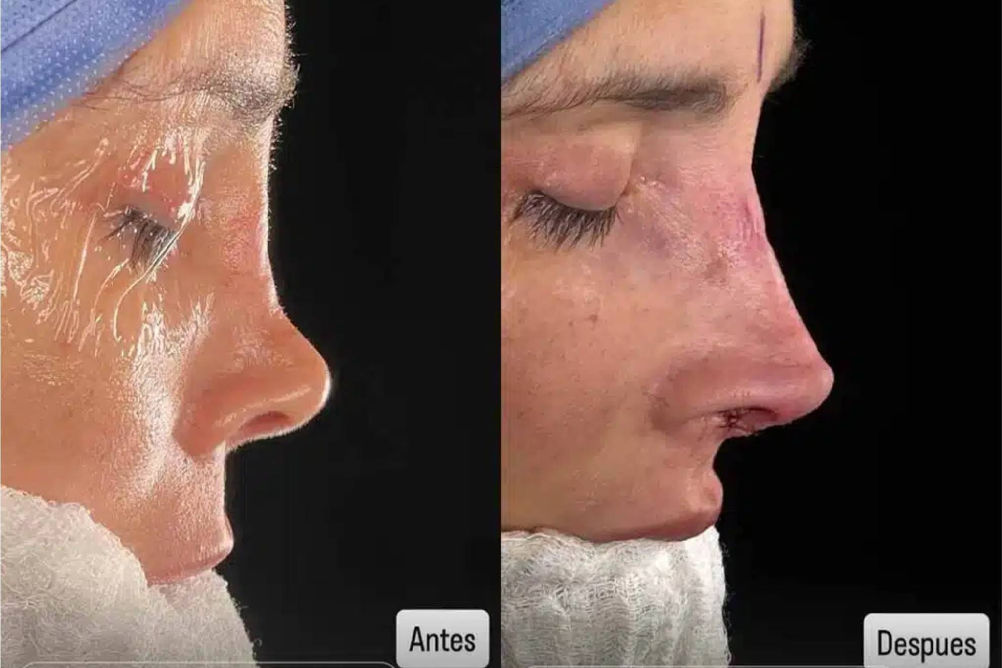 La modelo argentina Dorismar reaparece con cara desfigurada tras mala cirugía plástica.