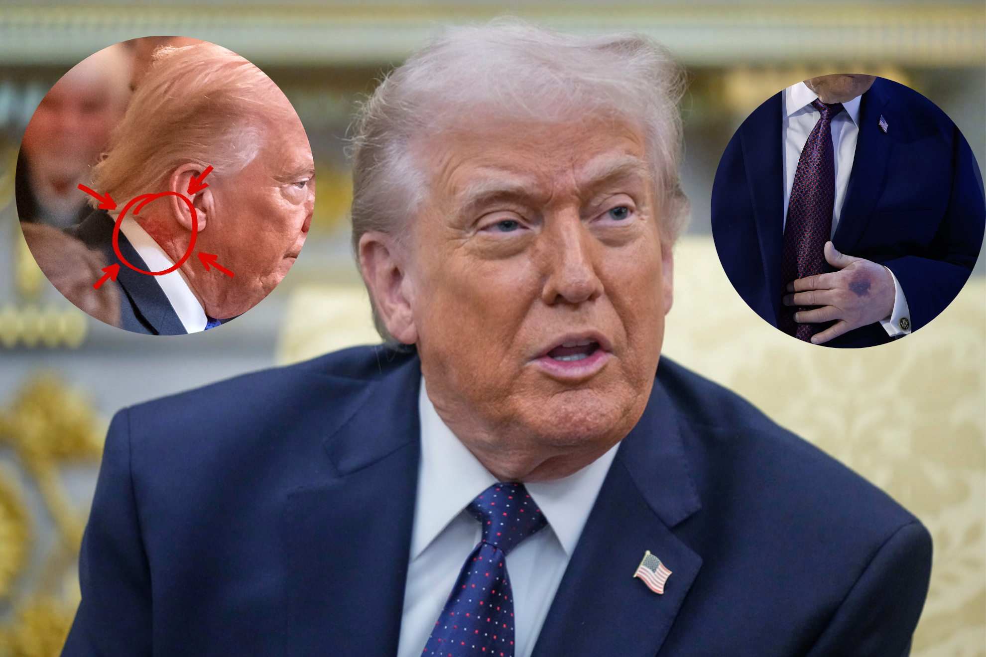 �Qu� es la insuficiencia venosa cr�tica y sus riesgos? As� es la enfermedad que tiene Donald Trump