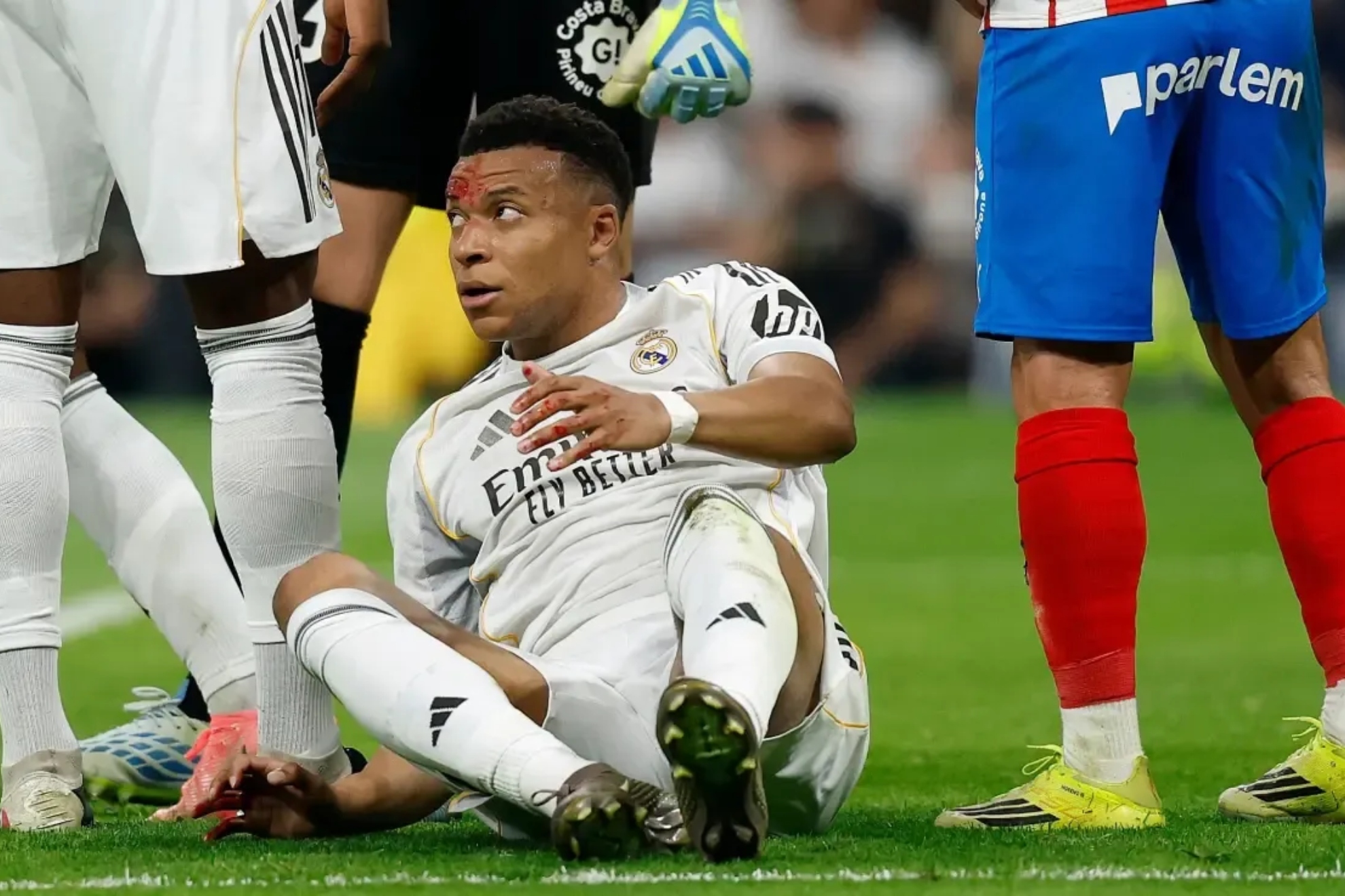 Mbapp�, con la cara ensangrentada tras la jugada de la pol�mica